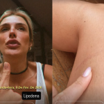 Rafa Brites revela diagnóstico de lipedema: “Vivo com roxos que eu não sei da onde é”