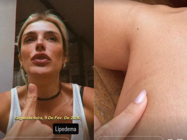 Rafa Brites revela diagnóstico de lipedema: “Vivo com roxos que eu não sei da onde é”