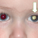 Retinoblastoma: especialista explica câncer nos olhos que acomete crianças