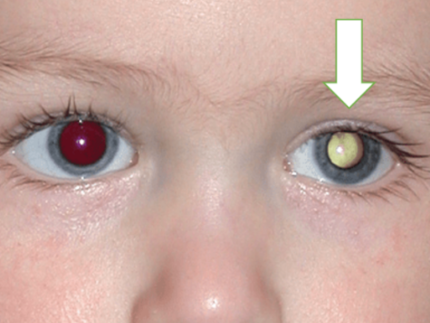 Retinoblastoma: especialista explica câncer nos olhos que acomete crianças