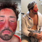 Rico Melquiades revela detalhes de tratamento para cicatrizes de acne: “Bem dolorido”