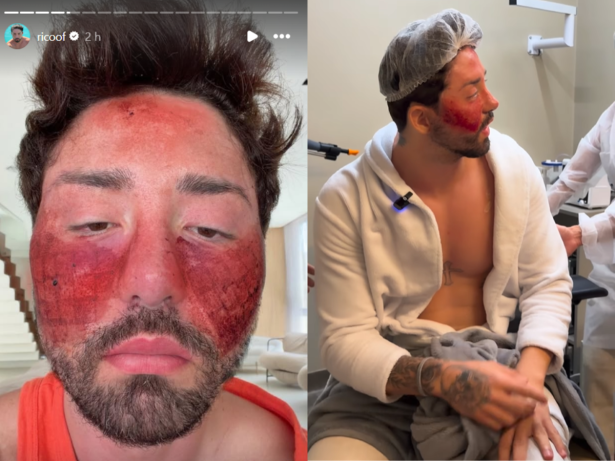 Rico Melquiades revela detalhes de tratamento para cicatrizes de acne: “Bem dolorido”