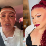 Humorista Luisa Marilac aparece com rosto inchado após transplante capilar