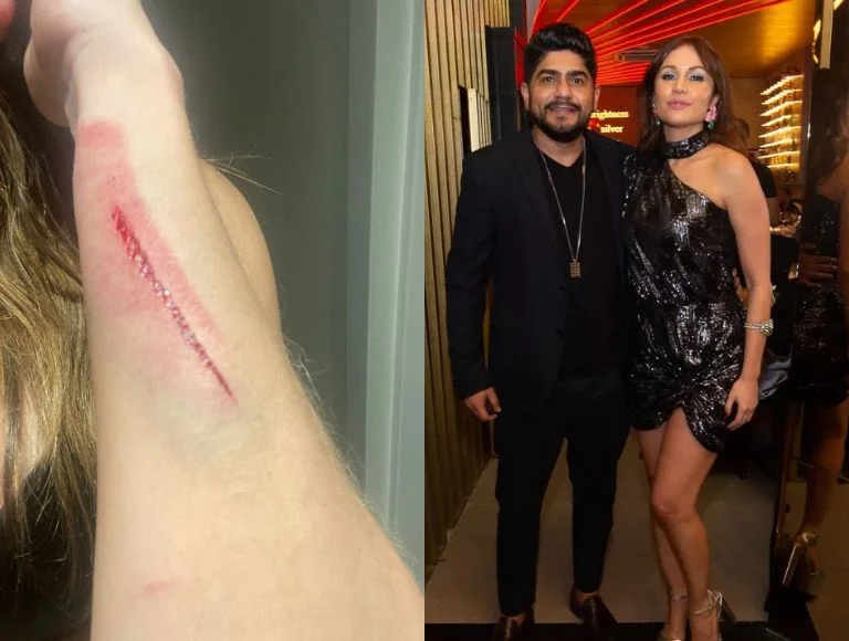 Fotos mostram hematomas e cortes após Maria Melilo ser agredida por namorado