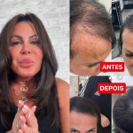 Gretchen mostra antes e depois da evolução do cabelo após tratamento para alopecia