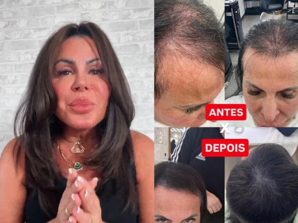 Gretchen mostra antes e depois da evolução do cabelo após tratamento para alopecia