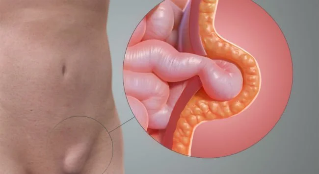 hernia inguinal