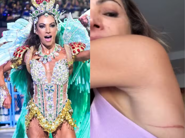 Patrícia Poeta mostra ferimentos após desfile como musa da Grande Rio. Veja!