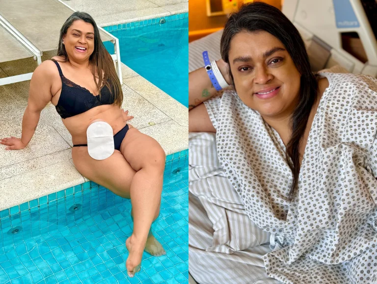 Preta Gil posta última foto com bolsa de ileostomia antes de cirurgia de reversão