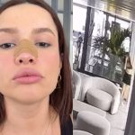 Juliette mostra nariz com curativo após acidente em porta de vidro