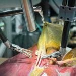 Pela 1ª vez na história da medicina, robô faz cirurgia guiada por IA sem ajuda de humano