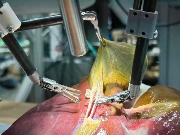 Pela 1ª vez na história da medicina, robô faz cirurgia guiada por IA sem ajuda de humano