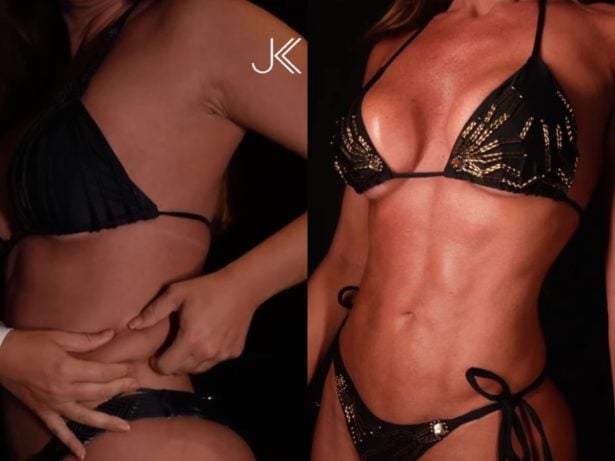 Nicole Bahls exibe resultado de Lipo HD e surpreende com antes e depois