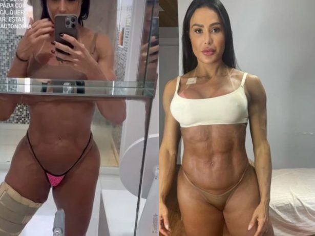 “Zero preocupada com estética”: Gracyanne surge com perna enfaixada após cirurgia