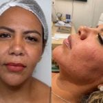 Mani Rego encerra o ano com harmonização facial e exibe o resultado