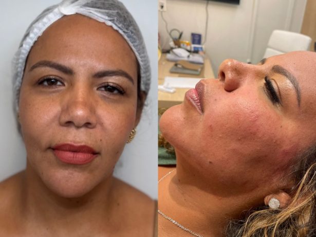 Mani Rego encerra o ano com harmonização facial e exibe o resultado