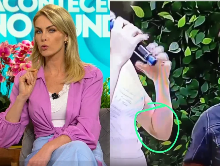 Veja pela 1ª vez hematoma de agressão de Ana Hickmann