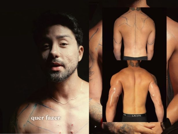 Rico Melquiades se submete a nova remodelação corporal após mais de dez cirurgias