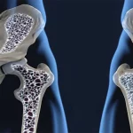 Osteoporose: o que você come hoje define a força dos seus ossos amanhã