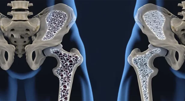 Osteoporose: o que você come hoje define a força dos seus ossos amanhã