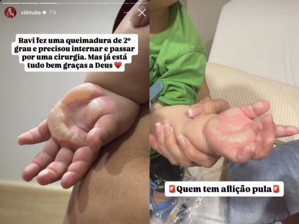 Filho de Viih Tube e Eliezer sofre queimadura de 2° grau, é internado às pressas e faz cirurgia