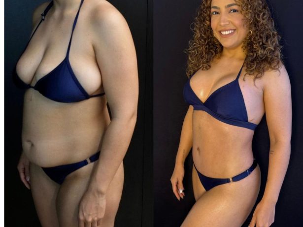 Camila Moura mostra resultado das cirurgias plásticas após perder 40 kg
