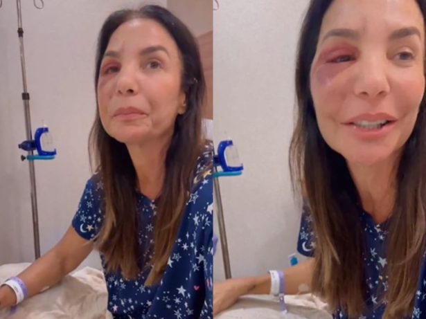 Ivete Sangalo explica cirurgia no rosto após queda e internação: “Lesão grave”