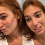 Em tratamento para acne, Vanessa Lopes relata ter se acostumado com ofensas