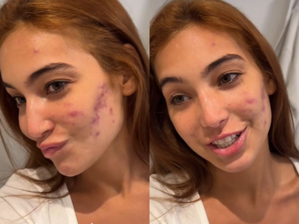 Vanessa Lopes detalha evolução do tratamento de acne: “Dói muito”