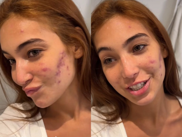 Em tratamento para acne, Vanessa Lopes relata ter se acostumado com ofensas