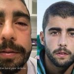 Pedro Scooby aparece com rosto inchado e se explica