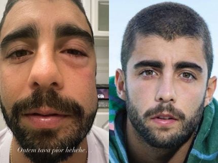 Pedro Scooby aparece com rosto inchado e se explica