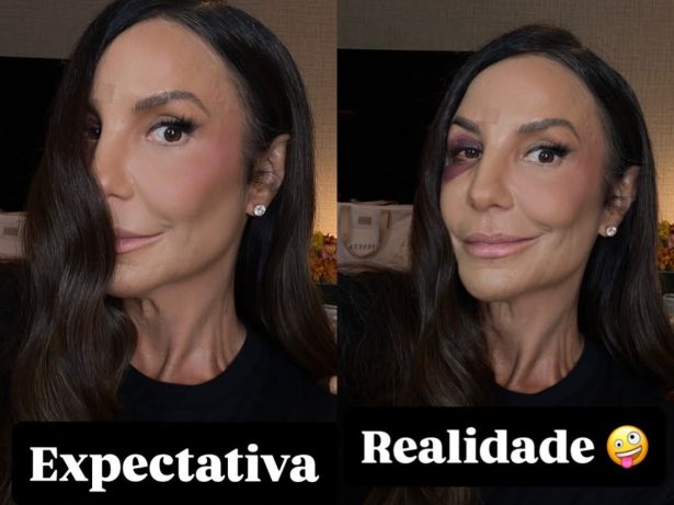 Expectativa x realidade: Ivete Sangalo mostra como ficou o rosto após cair e se machucar