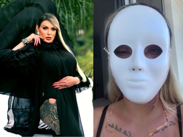 Andressa Urach mostra novo rosto após 50ª cirurgia plástica: “Vou ter 23 anos novamente”